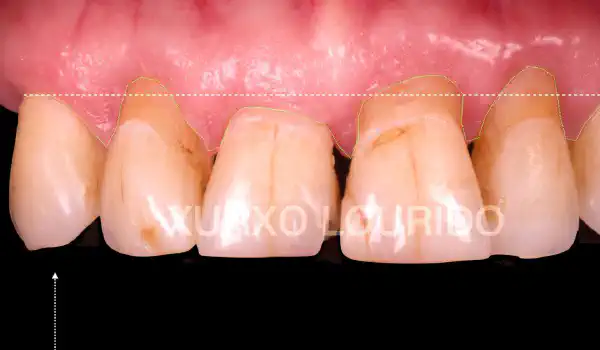 Image for case report Implant-supported rehabilitation of the maxillary ridge: Integration of surgical, periodontal and prosthetic concepts