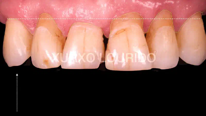Implant-supported rehabilitation of the maxillary ridge: Integration of surgical, periodontal and prosthetic concepts