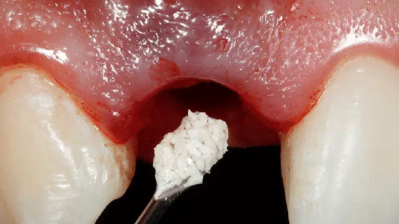 Immediate implant placement and function in the esthetic zone with a Straumann® BLX implant