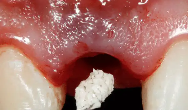 Image for case report Immediate implant placement and function in the esthetic zone with a Straumann® BLX implant