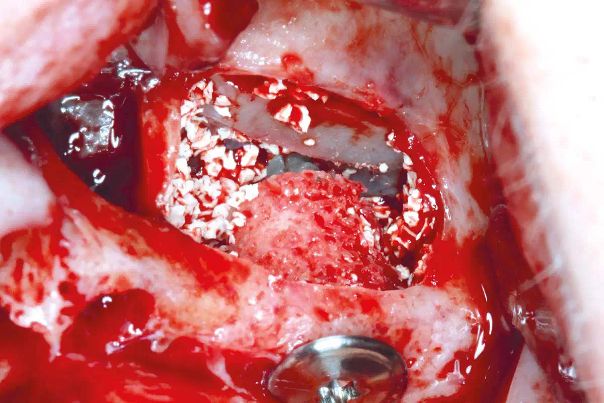 Case Report of maxgraft® bonering shows successful regeneration of buccal and lingual bone and immediate implant placement with a predictable clinical and esthetic outcome.