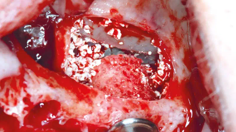 Case Report of maxgraft® bonering shows successful regeneration of buccal and lingual bone and immediate implant placement with a predictable clinical and esthetic outcome.