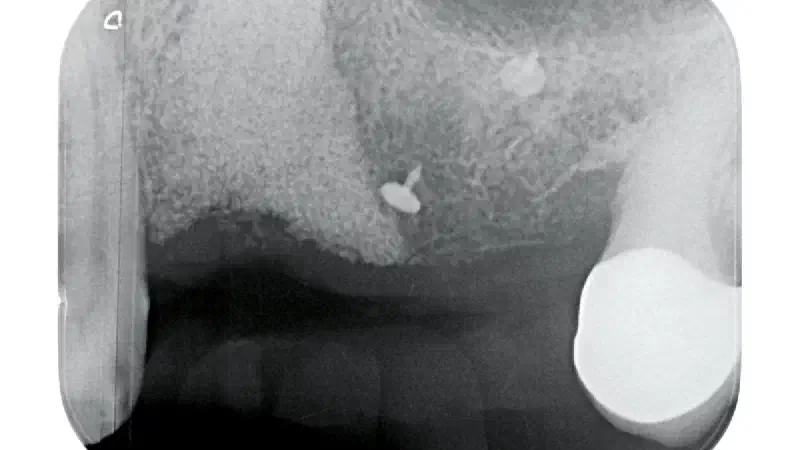 Reconstruction of a complex post-extraction defect using NOVAMag® membrane in combination with cerabone® and Jason® membrane