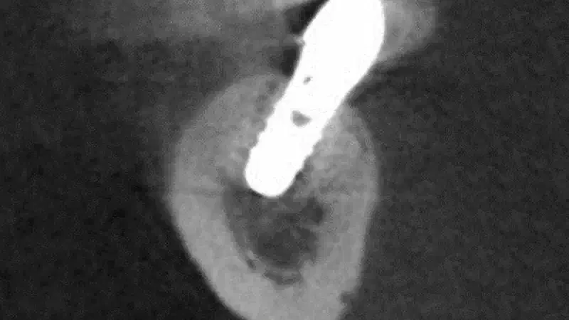 Dental Implant Placement in Focal Osteoporotic Bone Marrow Defect: a Case Report and Treatment Recommendations