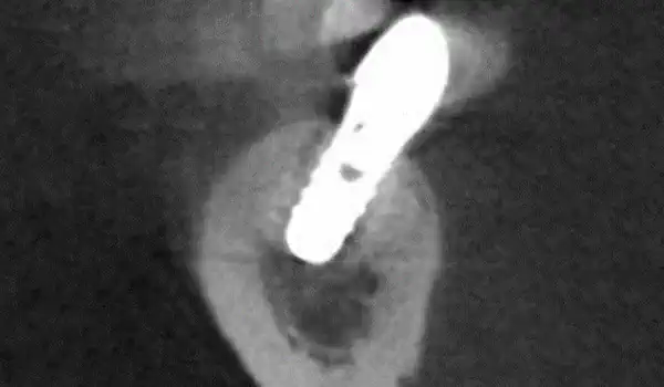 Image for case report Dental Implant Placement in Focal Osteoporotic Bone Marrow Defect: a Case Report and Treatment Recommendations