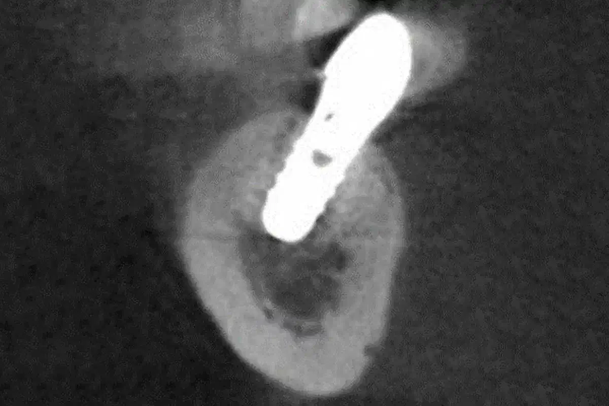 Dental Implant Placement in Focal Osteoporotic Bone Marrow Defect: a Case Report and Treatment Recommendations