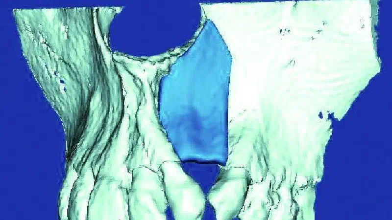 New indication for maxgraft® bonebuilder: First report worldwide about custom-milled allogeneic bone grafts for alveolar cleft osteoplasty