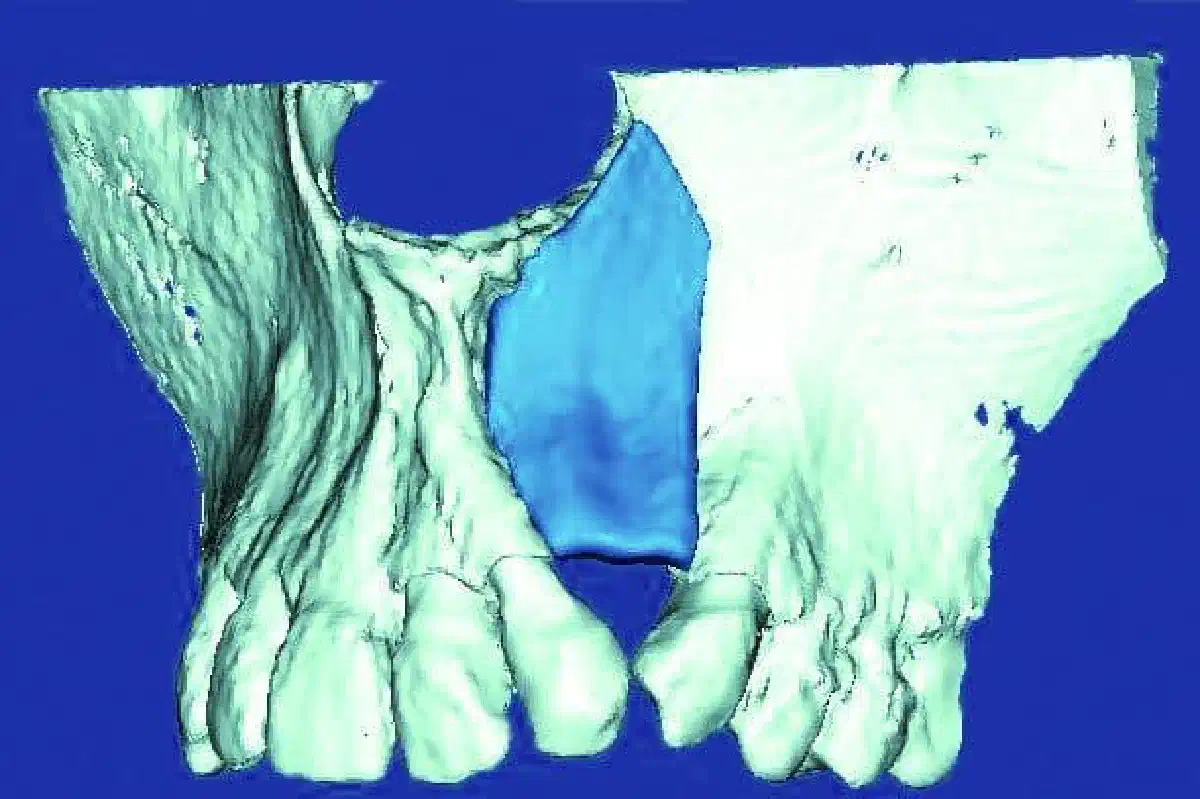 New indication for maxgraft® bonebuilder: First report worldwide about custom-milled allogeneic bone grafts for alveolar cleft osteoplasty