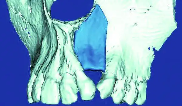Image for case report New indication for maxgraft® bonebuilder: First report worldwide about custom-milled allogeneic bone grafts for alveolar cleft osteoplasty