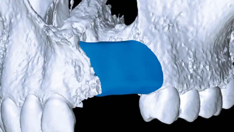 Reconstruction of a Unilateral Alveolar Cleft Using a Customized Allogenic Bone Block and Subsequent Dental Implant Placement in an Adult Patient