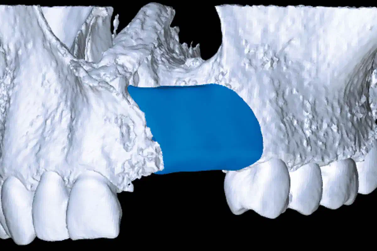 Reconstruction of a Unilateral Alveolar Cleft Using a Customized Allogenic Bone Block and Subsequent Dental Implant Placement in an Adult Patient