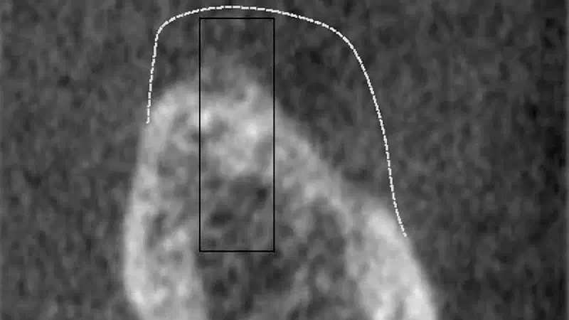 Posterior mandible reconstruction using cerabone® +HyA, permamem® and mucoderm® – A case report