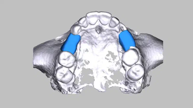 maxgraft® bonebuilder for the regeneration of two large osseous defects in the maxilla