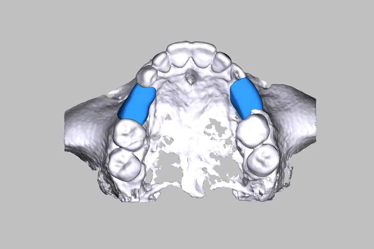 maxgraft® bonebuilder for the regeneration of two large osseous defects in the maxilla
