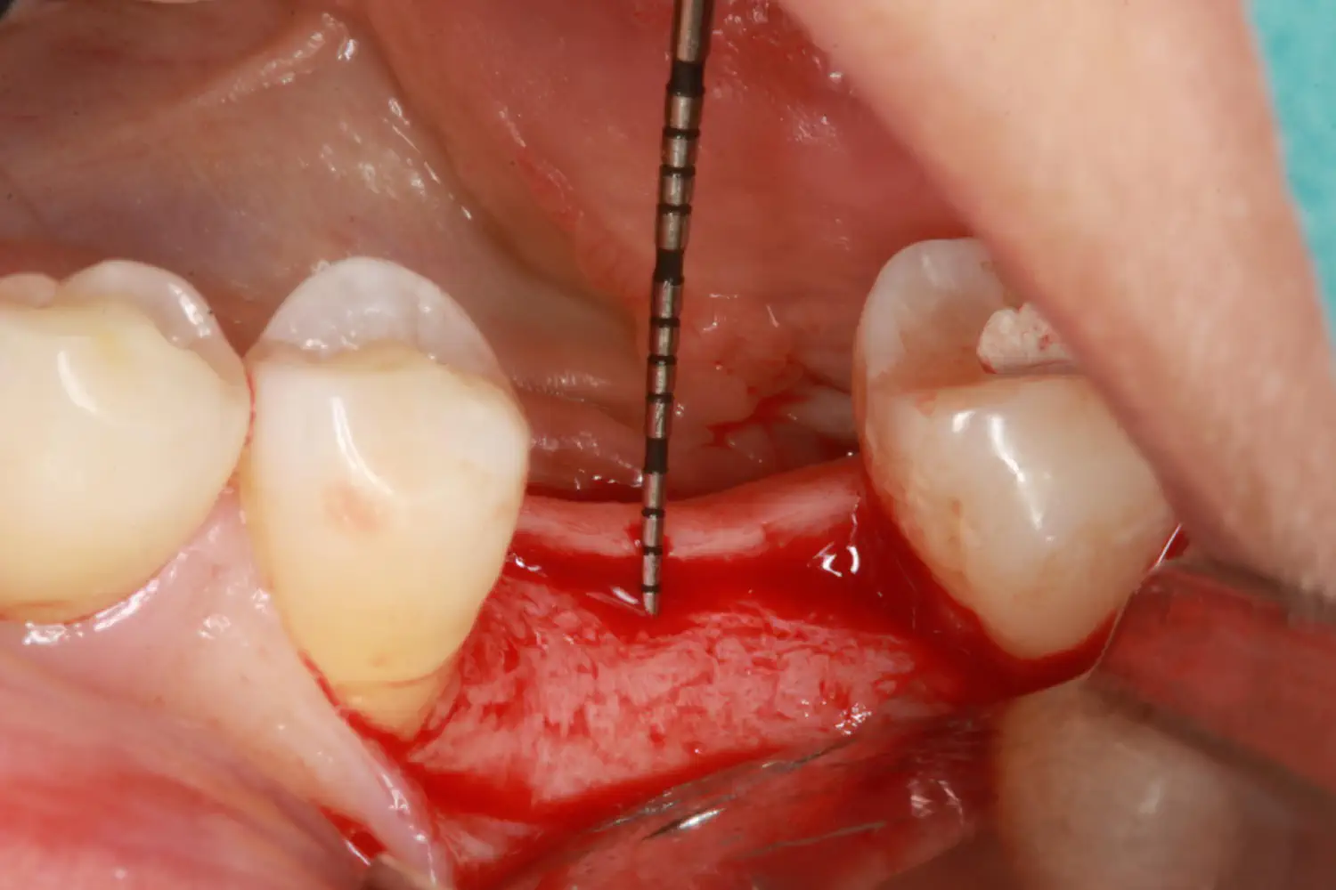 Puisys figure 3