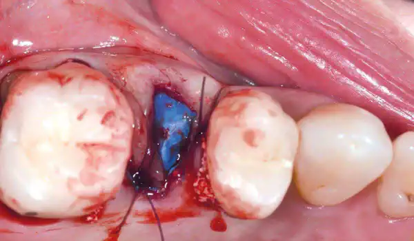 Image for case report Ice Cream Cone Technique with permamem®