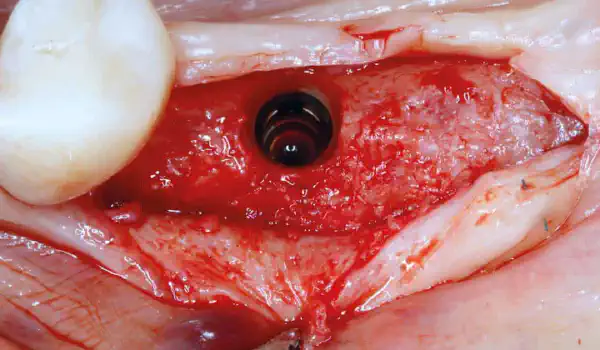 Image for case report Implant placement with simultaneous guided bone regeneration using 2mm healing abutment