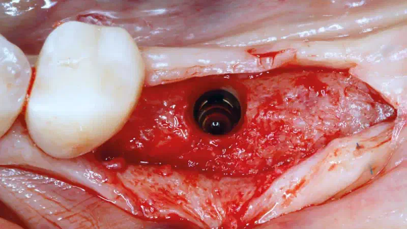 Implant placement with simultaneous guided bone regeneration using 2mm healing abutment