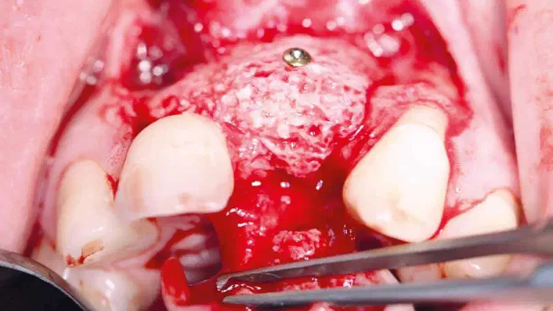 maxgraft® bonebuilder for alveolar reconstruction quantitated by a 3D matching technique: A case report