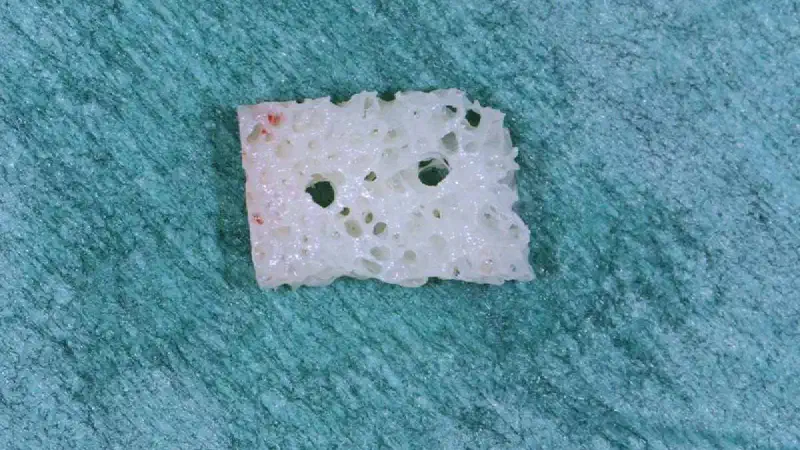 Hard tissue augmentation using an allogenic bone block: a clinical case report