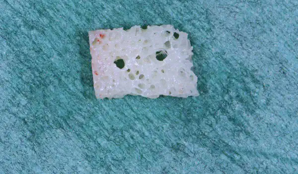 Image for case report Hard tissue augmentation using an allogenic bone block: a clinical case report