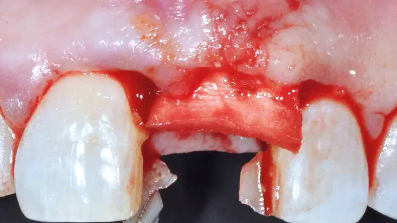 Socket sealing with mucoderm® in the aesthetic zone