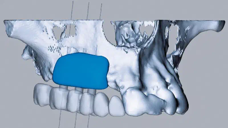 Case report shows full remodelling of maxgraft® bonebuilder after 5 years