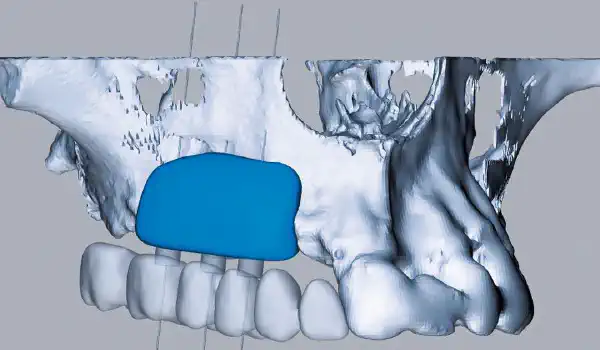 Image for case report Case report shows full remodelling of maxgraft® bonebuilder after 5 years