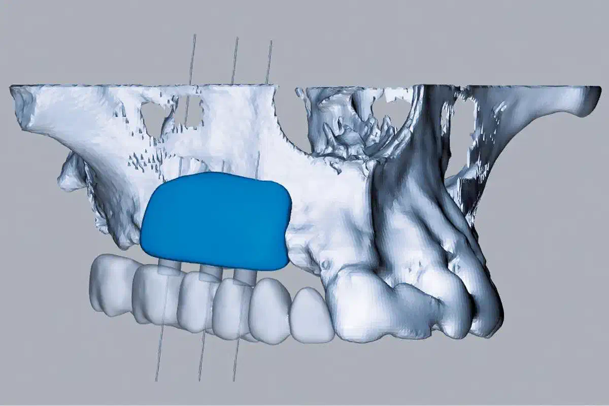 Case report shows full remodelling of maxgraft® bonebuilder after 5 years