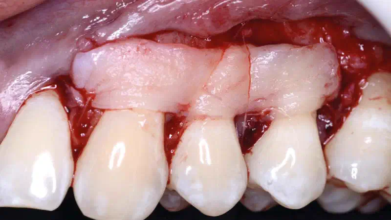 Tips for optimized mucoderm® handling