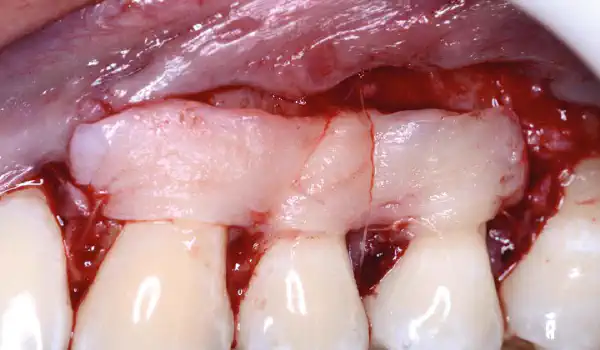 Image for case report Tips for optimized mucoderm® handling