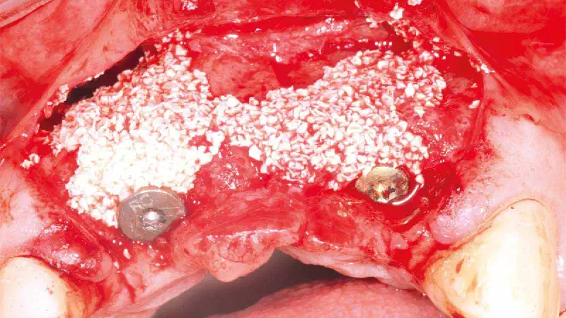 Replacement of a Failing Upper Anterior Bridge with Dental Implants