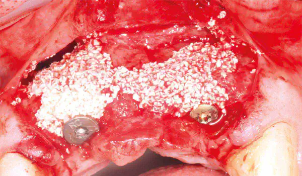 Image for case report Replacement of a Failing Upper Anterior Bridge with Dental Implants
