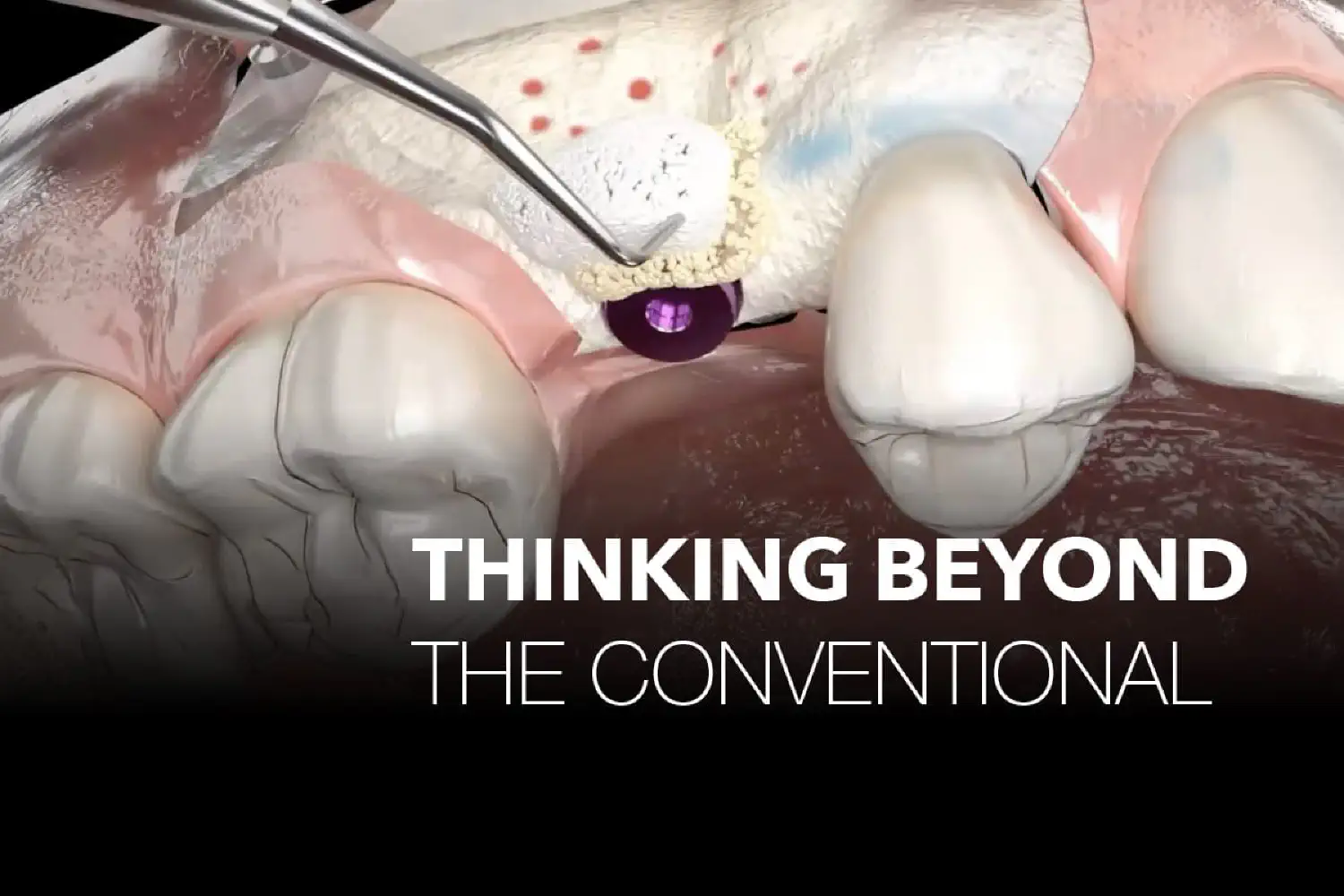 Aesthetic zone implant case with clinical solutions. Thinking beyond conventional dentistry.