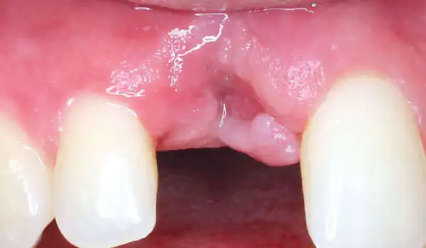 Image for case report Guided Surgery for Bone Ring Technique
