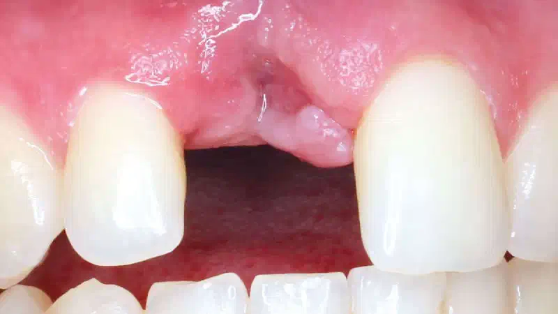Guided Surgery for Bone Ring Technique