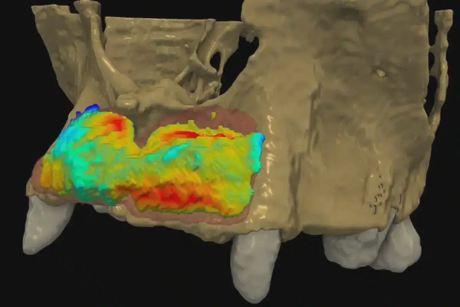 Efficacy and volume stability of maxgraft® bonebuilder