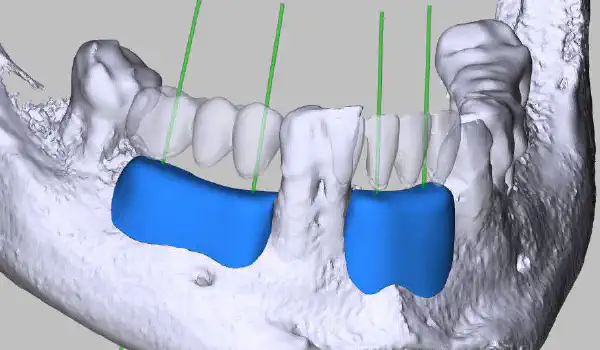 Image for case report Implant-prosthetic rehabilitation using individualized allogeneic bone blocks for bone defects caused by peri-implantitis