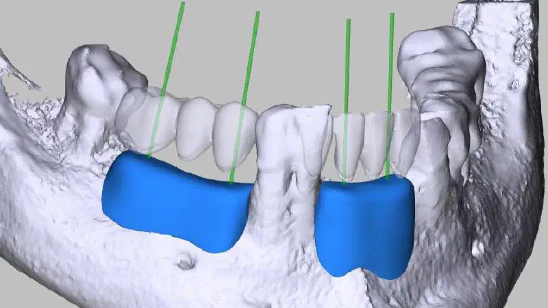 Implant-prosthetic rehabilitation using individualized allogeneic bone blocks for bone defects caused by peri-implantitis