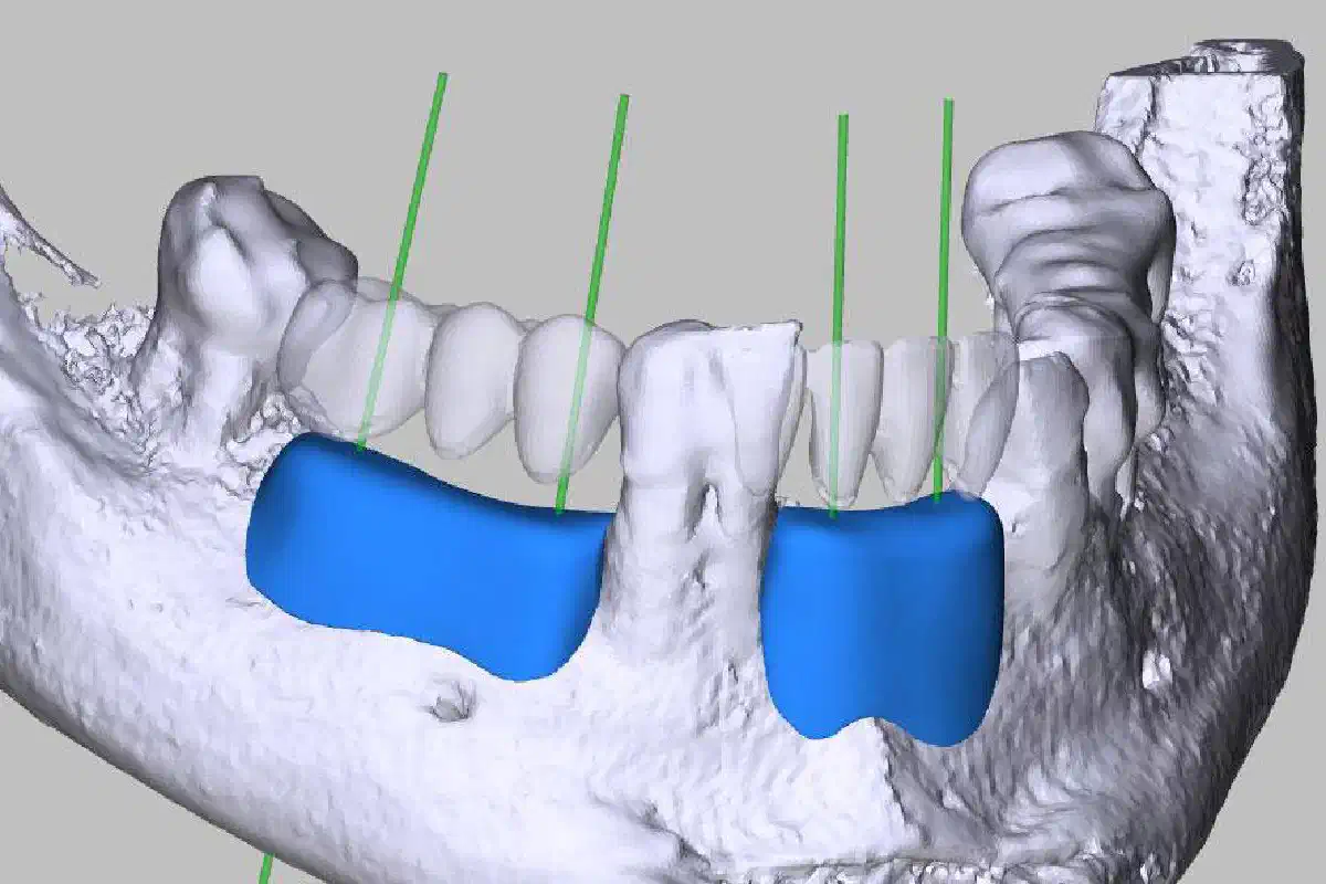 Implant-prosthetic rehabilitation using individualized allogeneic bone blocks for bone defects caused by peri-implantitis