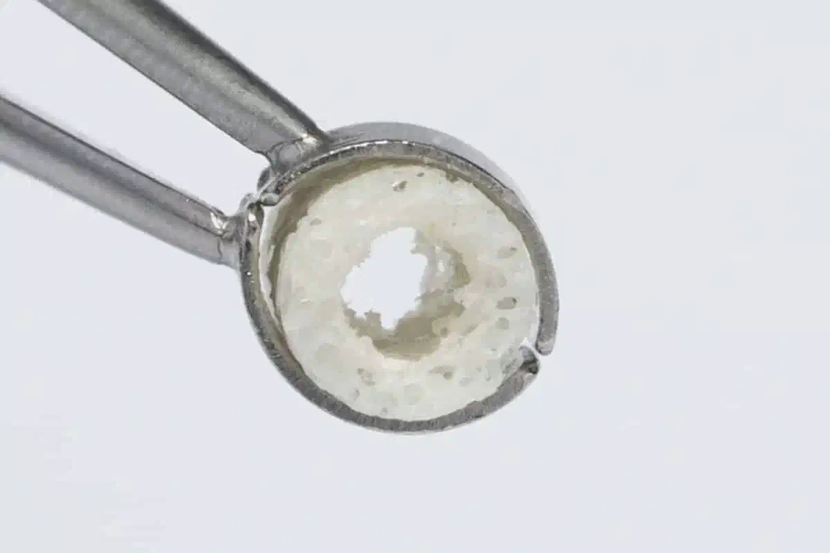 Bone Augmentation and Simultaneous Implant Placement with Allogenic Bone Rings and Analysis of Its Purification Success