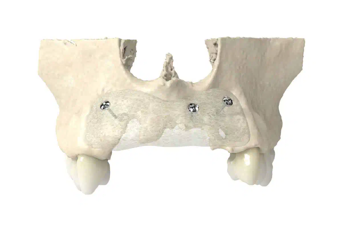 Treatment of Severely Resorbed Maxilla with maxgraft® bonebuilder