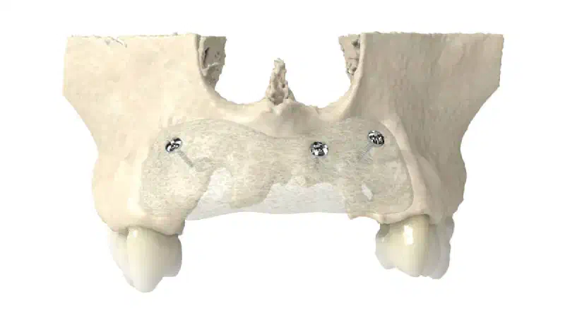 Treatment of Severely Resorbed Maxilla with maxgraft® bonebuilder
