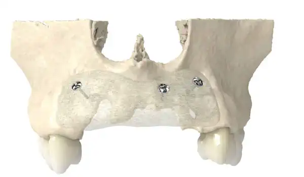 Image for case report Treatment of Severely Resorbed Maxilla with maxgraft® bonebuilder