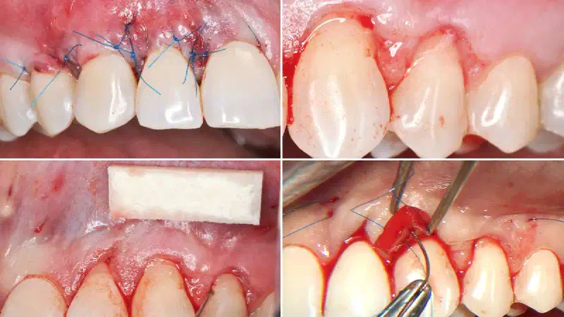 Plastic periodontal surgery combining mucoderm® and Emdogain®