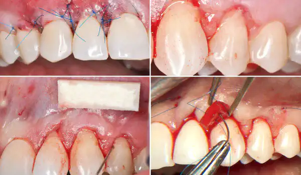 Image for case report Plastic periodontal surgery combining mucoderm® and Emdogain®