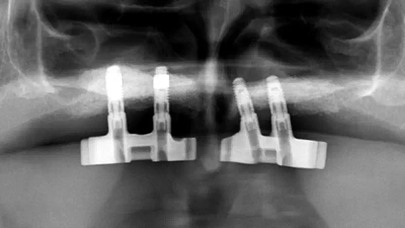 Nasal Floor Elevation – An Option of Premaxilla Augmentation: A Case Report
