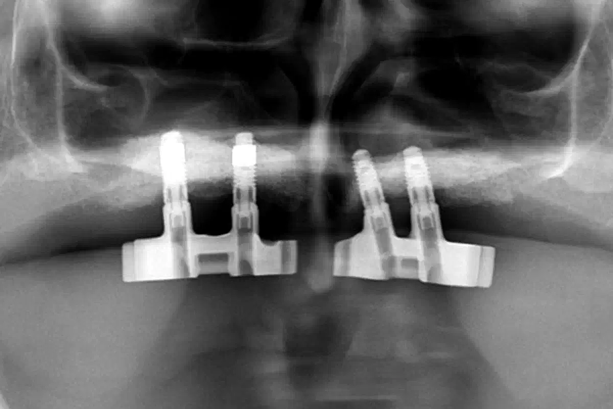 Nasal Floor Elevation – An Option of Premaxilla Augmentation: A Case Report