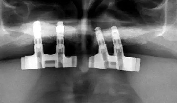 Image for case report Nasal Floor Elevation – An Option of Premaxilla Augmentation: A Case Report