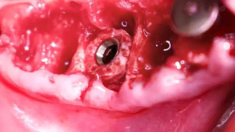 Restoration of a 3D bony defect in region 46 with pre-fabricated allograft bone rings and simultaneous implantation
